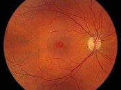 Macular hole, center, disrupts light and causes distortion and blurred vision.