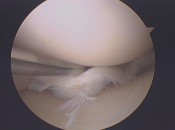 Not a portrait of the author, but pretty close to what my own meniscus tear looked like.