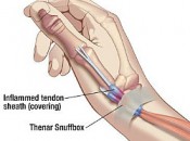 DeQuervain's Syndrome is a painful condition affecting tendons where the wrist and thumb meet.
